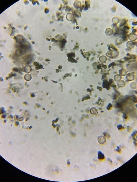 Biscogniauxia mediterranea spores at 1000x magnification, the microscopic confirmation of a charcoal canker diagnosis